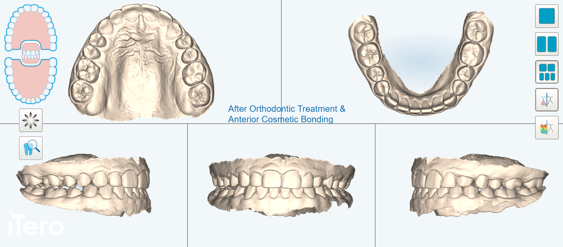 Patient-5-Invisalign-Bonding-After-2-